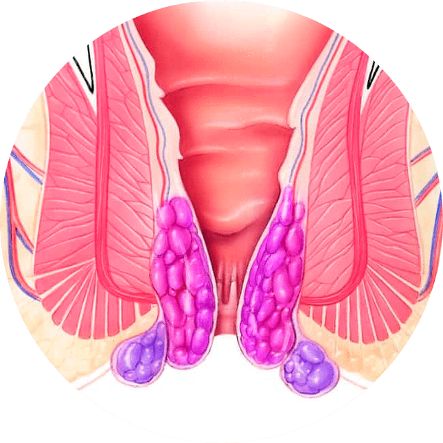 Gelarex lindert die Symptome bereits bei der ersten Anwendung